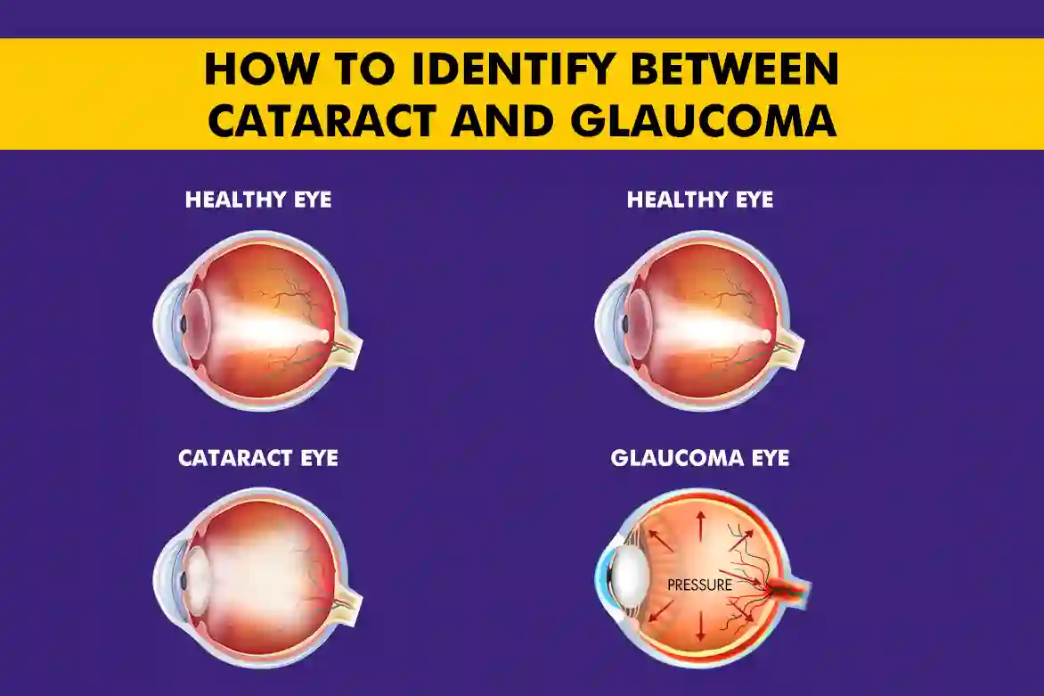 How to Identify Between Cataract and Glaucoma