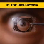 ICL for High Myopia