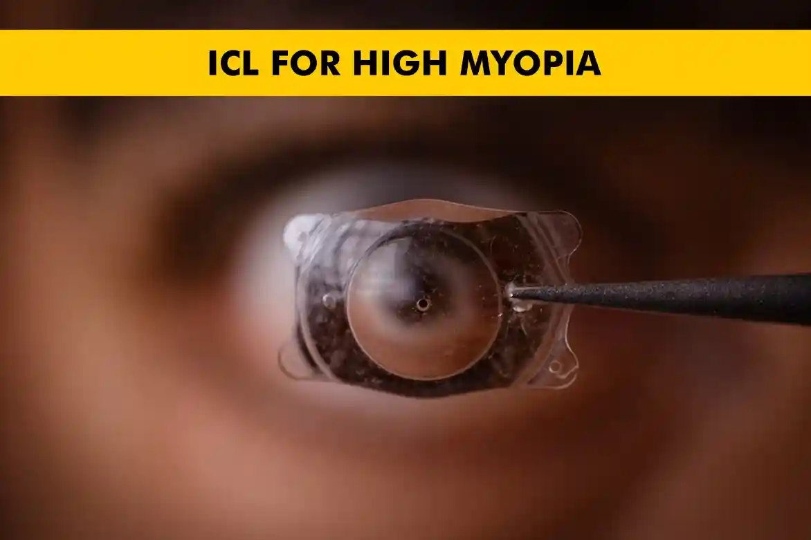 ICL for High Myopia